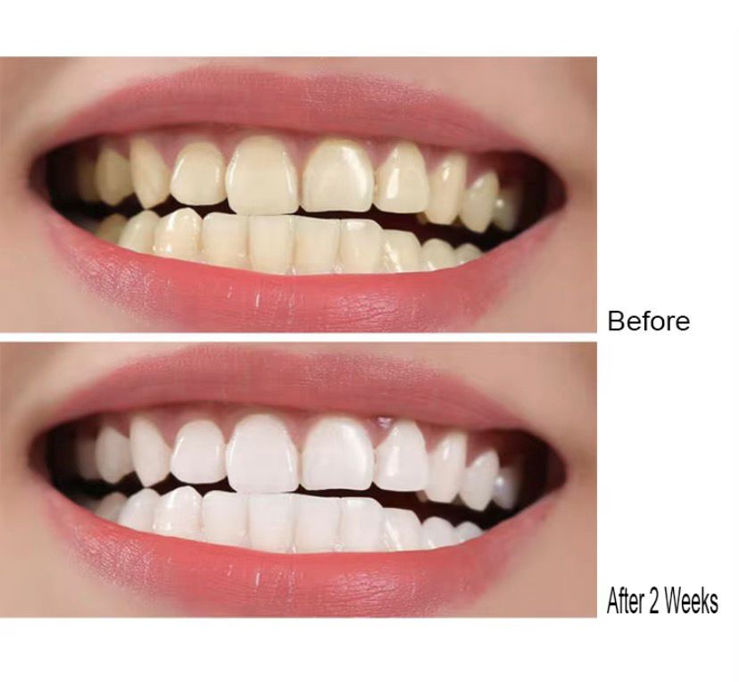 Imagem 6 do produto: Caneta clareadora dental 3ML plástico