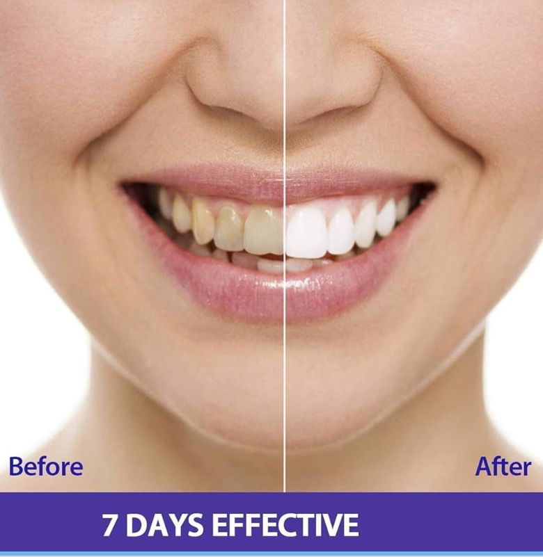 Imagem 4 do produto: Caneta clareadora dental 3ML plástico